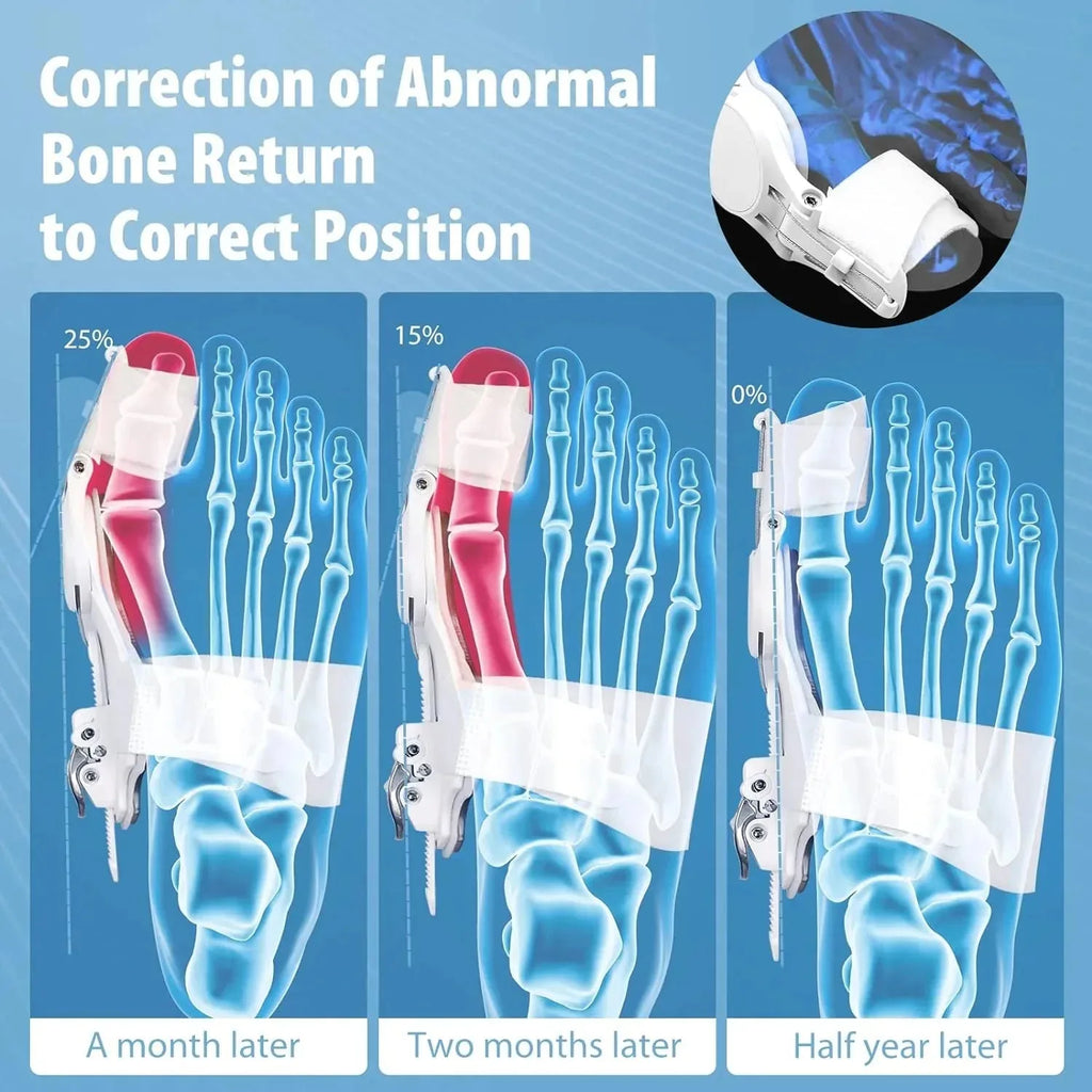 Bunion Corrector - Adjustable Bunion Splint